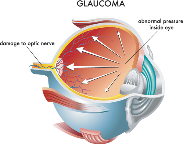 glaucoma west new york